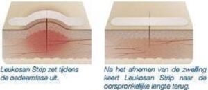 Leukosan Strip Ster 6x38mm (6 stuks) + 6x75mm (3 stuks) 72628-16 (9 stuks) - Afbeelding 2