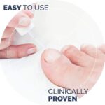 Scholl Kalknagel Behandelset - 1 Stuk